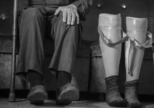 成人假肢订做视频大全集,成人假肢定制工艺与案例解析